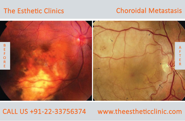 Choroidal Metastasis Eye Cancer Treatment before after photos in mumbai india (1)